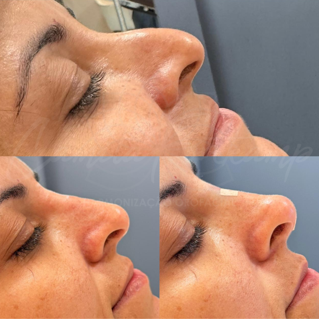 Antes & depois facial